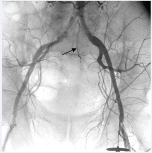 Рис. 2. Средняя сакральная артерия (указана стрелкой) доходит до ректосигмоидного и верхнеампулярного отдела	