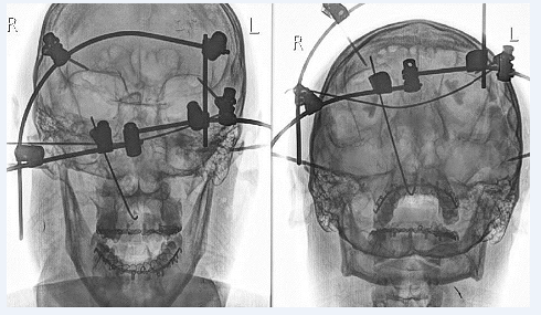 Рис. 2. Контрольная рентгенограмма пострадавшего И. после операции