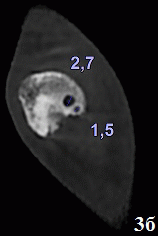 Рис. 3. Данные лучевых исследований левой стопы с признаками вальгусной деформации I пальца. При КЛКТ (а, б) и цифровой микрофокусной рентгенографии с прямым 3-кратным увеличением изображения (в) получены убедительные данные о структурной перестройке костной ткани в виде изменения направления костных балок на уровне головки проксимальной фаланги и головки плюсневой кости I пальца. На мультипланарных КЛКТ визуализируются очаги разряжения от 1,5 мм, соответствующие кистовидной перестройке, но достоверно не определяются при цифровой микрофокусной рентгеногрфии с прямым многократным увеличением изображения
