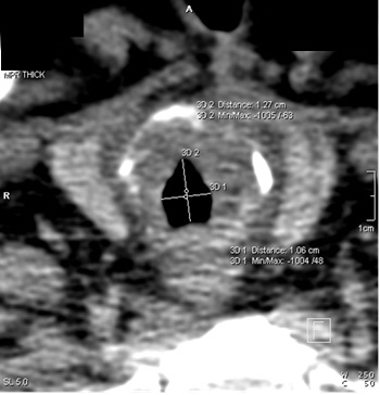 Рис. 3. МСКТ пациента Л., 43 года. Суженный отдел трахеи (1,27 × 1,06 см), аксиальная проекция.