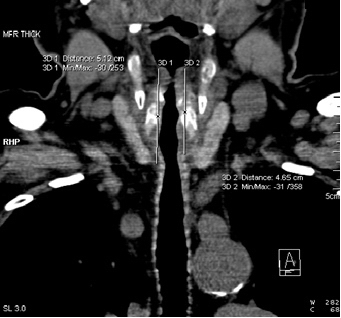 Рис 7. МСКТ пациента Л., 43 года. Протяженность суженного отдела трахеи (5,12-4,65 см), фронтальная проекция.