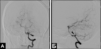 Рис. 4. Церебральная ангиография. На серии ангиограмм верифицируется мешотчатая артериальная аневризма области устья левой задней нижней мозжечковой артерии.