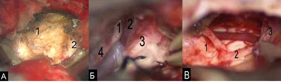 Рис. 9. А) (микроскопия) менингиома мосто-мозжечкового угла – 1, ткань мозжечка – 2; Б). диссекция ЧМН и сосудов на этапе удаления: тройничный нерв (n. trigeminus) – 1; вена Денди (v. flocularis) – 2; лицевой нерв (n. facialis) – 3; ствол мозга – 4; В). Стволовые структуры – 1; лицевой нерв (n. facialis) – 2; полушарие мозжечка – 3.