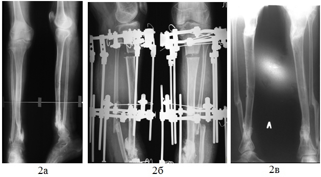 Рис. 2. Рентгенограммы голени больного Р., 16 лет в прямой и боковой проекциях, до лечения (а), в процессе лечения (б), после окончания (в).