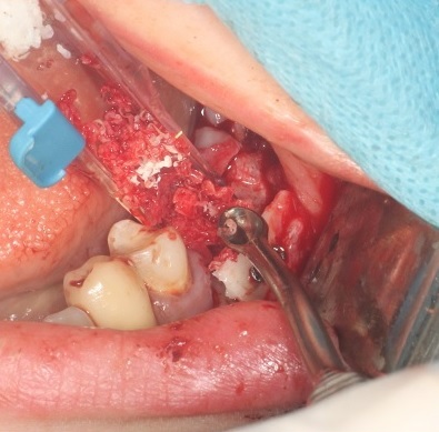 Рис. 4. Внесение костной стружки в пространство между областью реципиента и зафиксированным аутотрансплантатом.