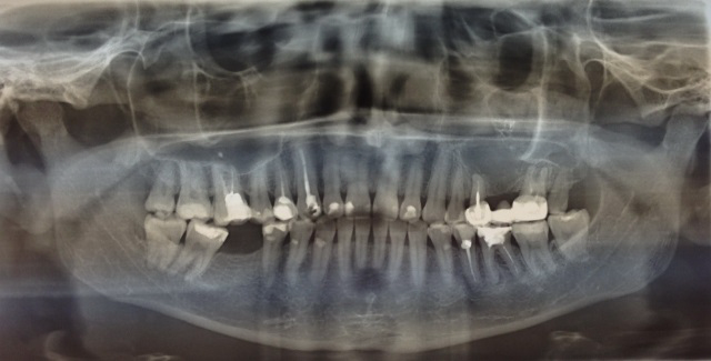 Пример ОПТГ – пациентка К. 35 лет, в области 4.6. дефект зубного ряда