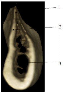 П-ка К. 35 лет, срез 3D изображения увеличенный костной ткани в области 4.6. отмечается атрофия альвеолярной части нижней челюсти по ширине (менее 5 мм), 1-щечная стенка, 2-альвеолярный гребень, 3 - свободнолежащие трабекулы