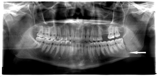Рис. 7. Ортопантомограмма нижней челюсти до операции. Стрелкой обозначена линия перелома