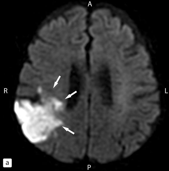Рис. 1. МР-изображения головного мозга: а – ДВИ, b = 1000 с/мм2; б – ИКД карта; в, г – ДТИ трактов внутренней капсулы с обеих сторон. Определяется обширная зона ишемии в правой теменной области (а, б). Зона снижения количества трактов в области задней ножки внутренней капсулы на стороне поражения