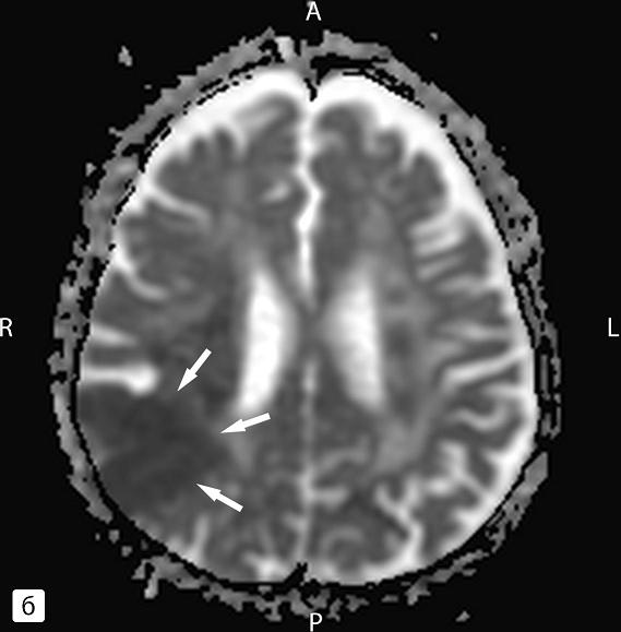 Рис. 1. МР-изображения головного мозга: а – ДВИ, b = 1000 с/мм2; б – ИКД карта; в, г – ДТИ трактов внутренней капсулы с обеих сторон. Определяется обширная зона ишемии в правой теменной области (а, б). Зона снижения количества трактов в области задней ножки внутренней капсулы на стороне поражения