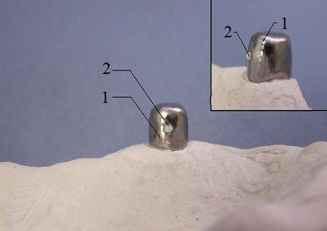 Рис. 2. Внутренняя телескопическая коронка (1), эластический шаровидный фиксатор (2)