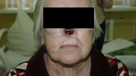 Рис.2. Пациентка Г. Остеофиксаторы установлены в полости носа.