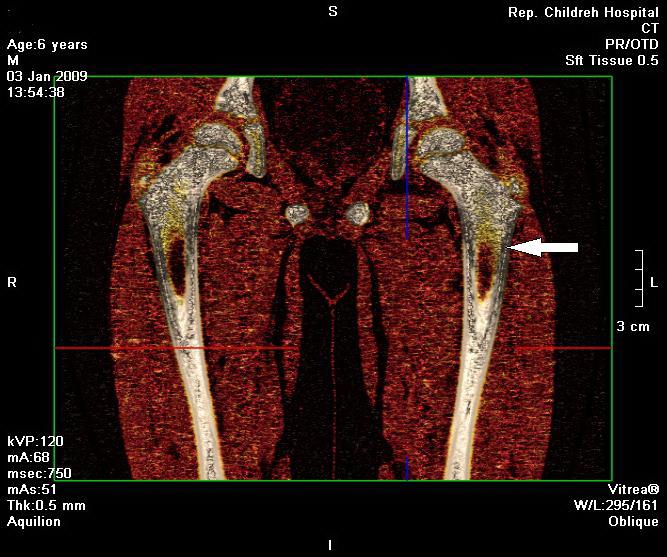 Рис. 2. Зона отека костного мозга бедренной кости при МСК с использованием методики цветного картирования