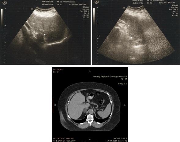 Рис. 3. Опухоль правого надпочечника (слева); опухоль левого надпочечника (справа); результаты РКТ (снизу).