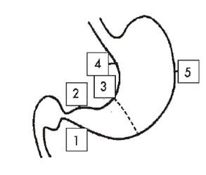 Рис. 1. Схема забора материала при биопсийном исследовании (1, 2 – большая и малая кривизна антрального отдела желудка; 3 – угол желудка; 4, 5 – большая и малая кривизна тела желудка).