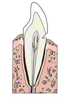 Рис. 1. Клиновидный дефект зуба [9].