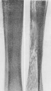 Рис. 1. Картина системного остеопороза в сравнении с нормальной структурой костной ткани.