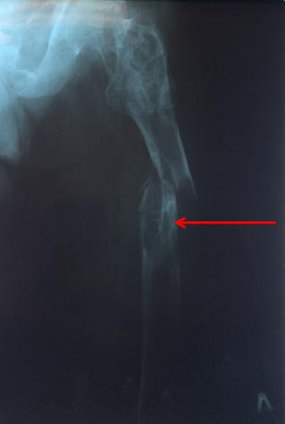 Рис. 7. Рентгенограмма левого бедра пациента А. до операции (стрелкой указана зона патологического перелома).