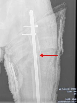 Рис. 8. Рентгенограмма левого бедра пациента А. 3е сутки после операции (стрелкой указан блокируемый интрамедуллярный остеосинтез).