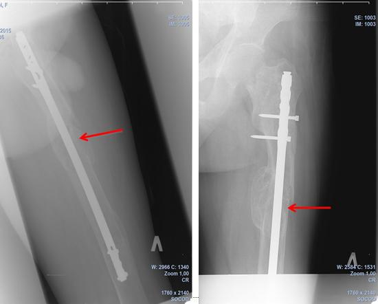 Рис. 9. Рентгенограмма левого бедра пациента А. через 1 год сутки после операции (стрелкой указана консолидация зоны перелома).