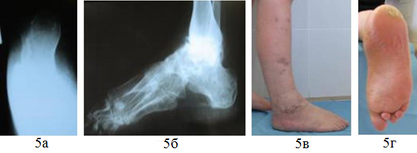Рис. 5. Больная З. 59 лет. Рентгенограммы правой стопы и внешний вид нижней конечности через 2 года после лечения: а – аксиальная проекция, б - боковая проекция, в - вид сбоку, г - вид на подошву.