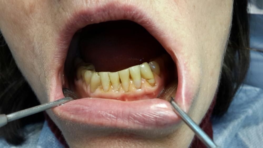 Рис. 1б. Гигиеническое состояние (отсутствие окрашивания) после использования зубной пасты с нейтрализаторами сахарных кислот.