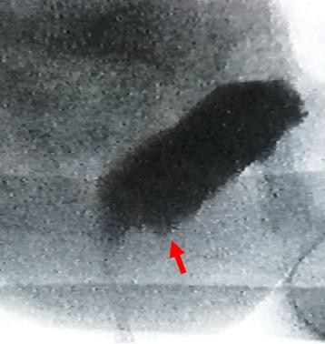 Рис. 7. Заднее ректоцеле при рентгеновской видеодефекоскопии (стрелка).