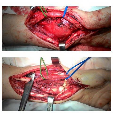 Рис. 3. Этапы операции. Мобилизация лучевой артерии, срединного нерва; удаление опухоли (дистальный метаэпифиз левой лучевой кости).