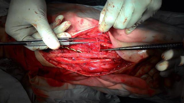 Рис. 6. Наложение сосудистого анастомоза «конец-в-бок» (участок малоберцовой артерии трансплантата к лучевой артерии).