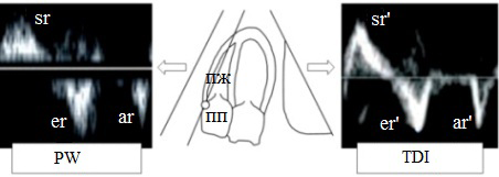 Рис. 1. По центру схема расположения датчика и контрольного объема для регистрации импульсноволновой спектрограммы на уровне фиброзного кольца трикуспидального клапана. Слева записанная спектрограмма обычного импульсноволнового допплера (PW). Справа спектрограмма тканевого допплера (TDI).