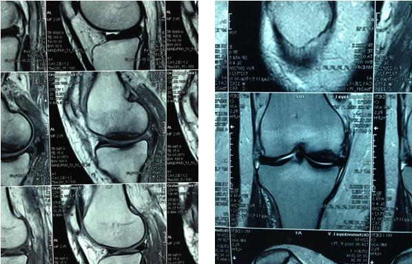 Рис. 2. Пациент Р., магнитно-резонансная томография коленного сустава.