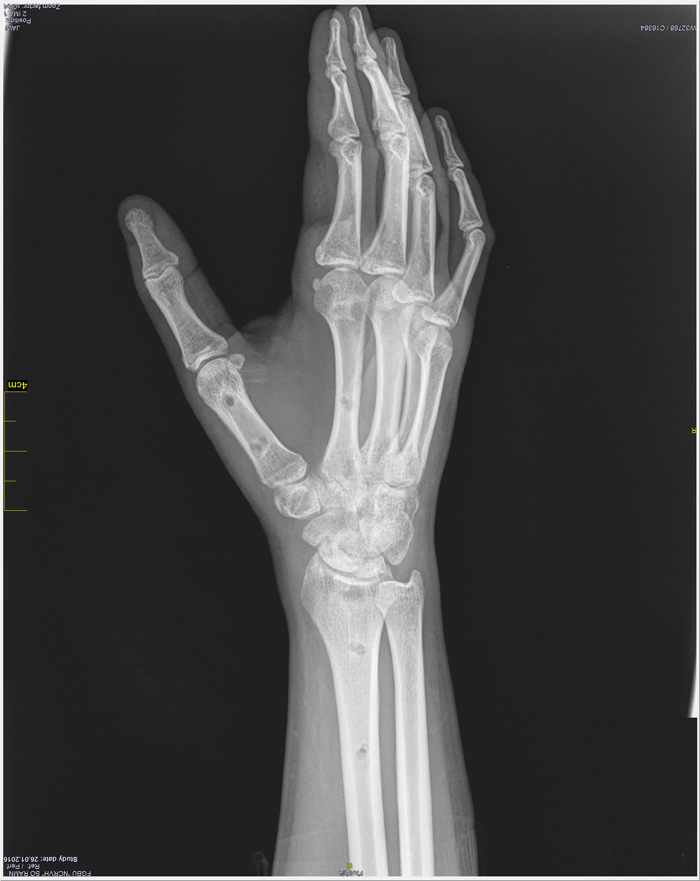 Рис. 3. Рентгенография правой кисти пациента через 12 месяцев с момента операции.