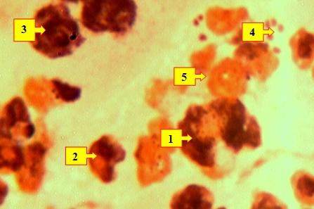 Рис. 1. Мазок отпечаток раны больного Д.Д. 1948 г.р. и.б.№1175/384, 2-е сутки лечения. Видны нейтрофильные лейкоциты (1), разрушенные лейкоциты (2), лимфоциты (3), микроорганизмы (4), белковые вещества (5). Окраска: Рамоновский-Гимза. Ув: ок.10, об. 40.