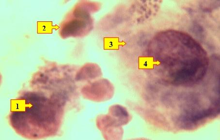 Рис. 2. Мазок отпечаток раны больного Т.И. 1961 г.р. и.б№250/94, 3-е сутки лечения. Определяются нейтрофильные лейкоциты (1), разрушенные лейкоциты (2), гистиоциты (3) с активацией ядра (4) в виде гиперхромазии с расширением цитоплазмы. Окраска: Ромоновский-Гимза. Ув: ок.10, об. 40. 