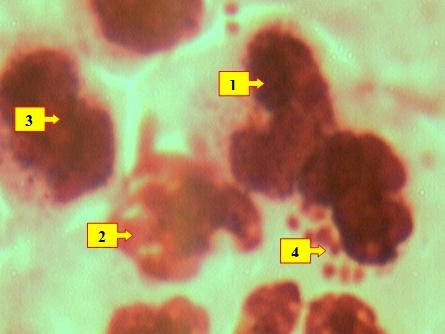 Рис.6. Нейтрофильные лейкоциты (1) с признаками фагоцитоза (разрушенные лейкоциты (2), лимфоциты (3), микроорганизмы (4)). Окраска: Ромоновский-Гимза. Ув: ок.10, об. 40.