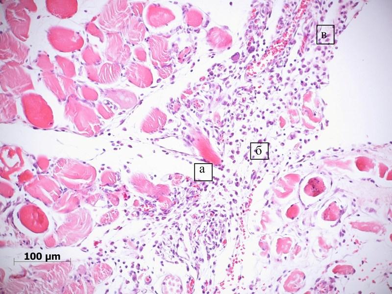 Рис. 4. Мышцы таза крысы после удаления пористого имплантата из никелида титана на 7-е сутки эксперимента. Врастание молодой соединительной ткани со стороны эндомизия в сторону имплантата (а). Выраженный лейкоцитарный инфильтрат (б) и гиперемия сосудов (в) в рыхлой соединительной ткани. Окраска гематоксилином и эозином.