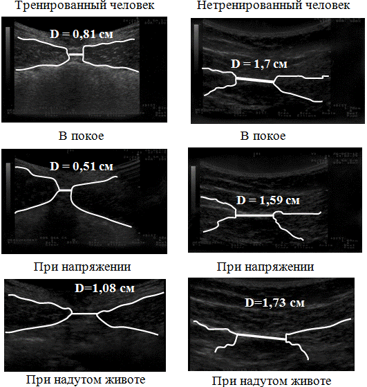 Рис. 2. Ультразвуковое изображение биомеханики пупочного кольца.