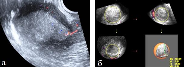 Рис. 6 (а, б). а) Трехмерное изображение тела матки в режиме максимальной прозрачности при раке эндометрия; б) оценка индекса васкуляризации.