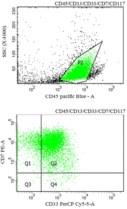 Рис. 2. Проточно-цитометрический анализ образца костного мозга больного ОМЛ М2 с коэкрессией СD7. На I-м дотблоте бокового светорассеяния и CD45 гейтирована бластная популяция. На II-м дотблоте в квадранте Q2 показаны клетки одновременно позитивные по двум антигенам CD7 и CD33.