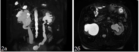 Рис. 2. МР-томограммы БП пацциента П., 56 лет. 3D MRCP в корональной проекции (а) и Т2-ВИ с подавлением сигнала от жировой ткани в аксиальной проекции (б). Отмечается двусторонняя уретеропиелокаликоэктазия (больше справа, расширение мочеточника достигает 31 мм), истончение паренхимы правой почки. На изученном уровне также визуализируются кисты печени и киста правой почки.