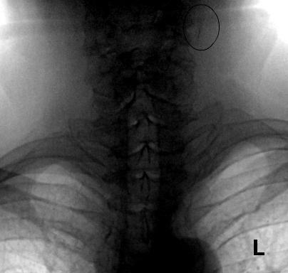 Рисунок 1. Пациентка, 63 года. Слева линейный кальцинат высокой плотности, более 4 мм, в проекции общей сонной артерии.