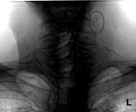 Рисунок 2. Пациент, 62 года. Слева множественные тени, от 2 мм до 13 мм, низкой плотности, в проекции общей сонной артерии. Атеросклероз аорты.