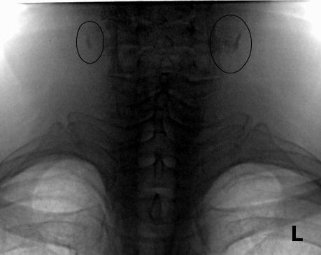 Рисунок 3. Пациент, 65 лет. Множественные тени кальцинатов, более 4 мм, высокой плотности в проекции бифуркаций сонных артерий с двух сторон.