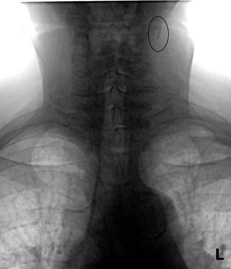 Рисунок 4. Пациентка, 77 лет. Слева четкообразный кальцинат, высокой плотности, более 4 мм. Атеросклероз аорты.