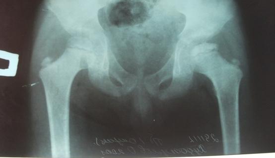 Рис. 1а. Больной Х.О., 7 лет. Рентгенография в прямой проекции.
