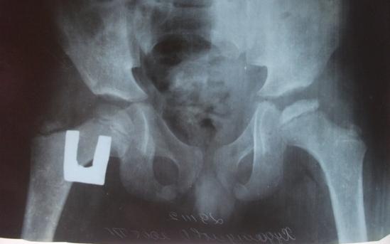 Рис. 1б. Больной Х.О., 7 лет. Рентгенография с отведением и внутренней ротацией нижних конечностей.