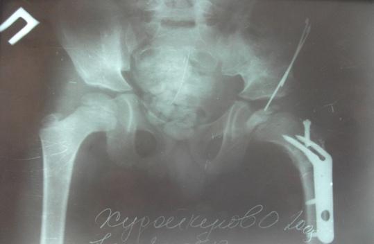 Рис. 2. Больной Х.О., 7 лет. Рентгенография через 3 месяца после операции.