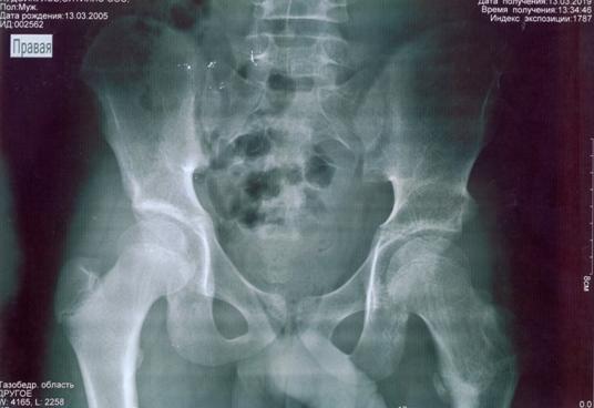 Рис. 3. Больной Х.О., 14 лет. Рентгенография в прямой проекции. Отдаленный результат через 7 лет после операции.